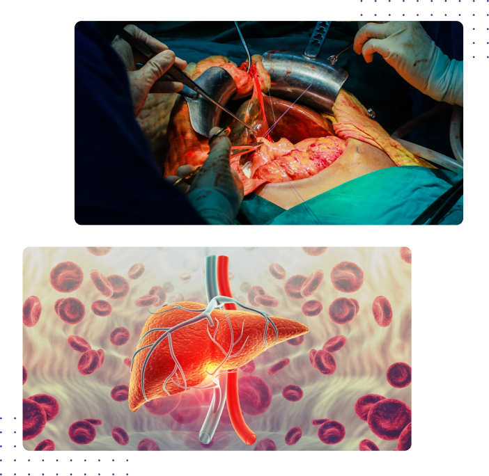Liver Transplantation in Coimbatore